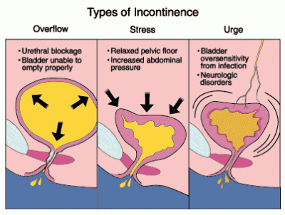 incontinence.gif
