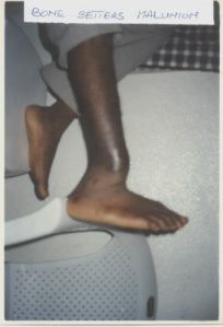 BONE_SETTERS_MALUNION.jpg