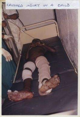 CRUSHED_INJURY_11.jpg