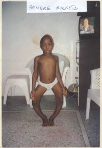 SEVERE_RICKETS.jpg