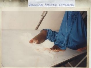 VASCULAR_DISEASE_GANGRENE.jpg