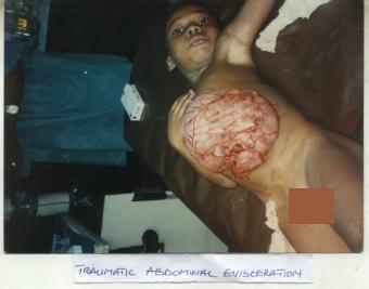 TRAUTMATIC_ABDOMINAL_EVISCERATION.jpg
