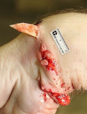 rail-road-injury1.jpg