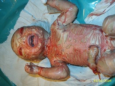harlequin_ichthyosis.jpg
