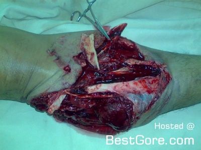 fractured-knee-02-500x374.jpg