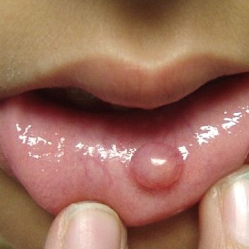 Lip_Mucocele_Child_353SQ.jpg