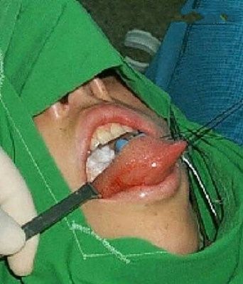 tongue-sweeling-removed.jpg