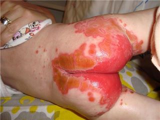 rash cancer.jpg