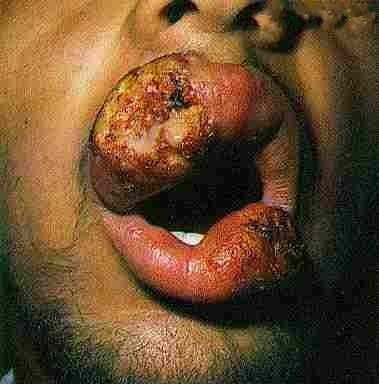 mouth-infection.jpg