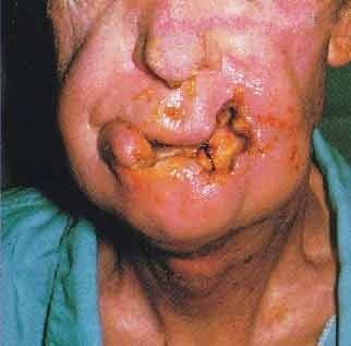mouth infection3.jpg
