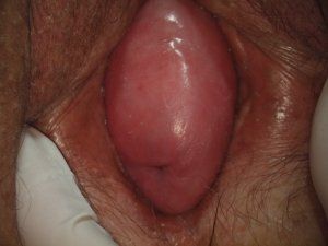 vagina prolapse11.jpg