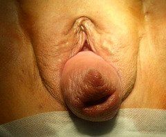 vagina prolapse8.jpg