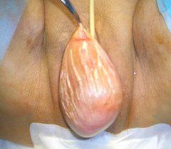 vagina prolapse10.jpg