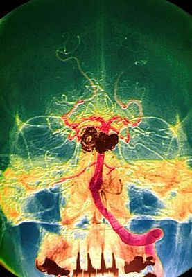 angiogram.jpg