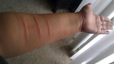 dermographic-ulticaria.jpg