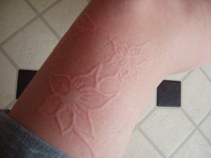 dermatographism_Die_Blumen_by_randomranma.jpg