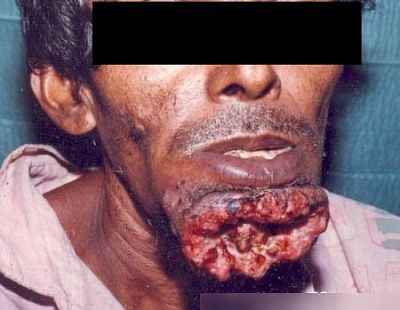 carcinoma2.jpg
