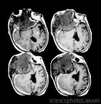 M3301626-MRI_Showing_Head_Trauma-SPL.jpg