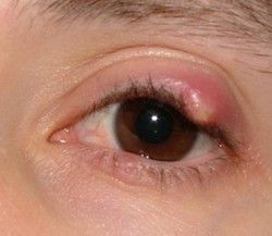 stye-remedies.jpg