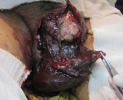 fourniers-gangrene-skin-sloughed-off-1-.jpg