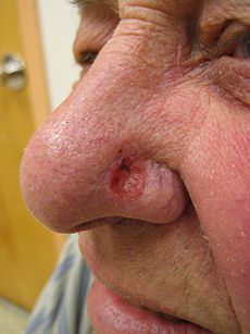 230px-Basal_cell_carcinoma2.JPG