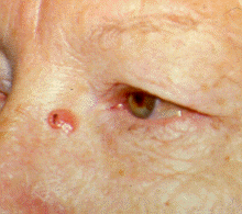 basal cell carcinoma 2.gif