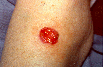 basal cell carcinoma arm.gif