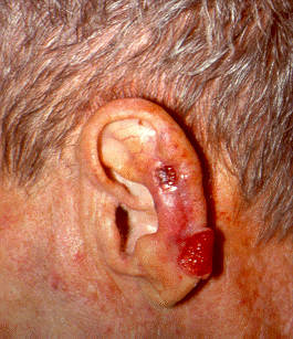 basal cell carcinoma ear.gif