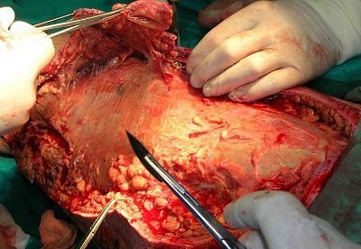 necrotizing_fasciitis_left_leg_debridement-1-.jpg