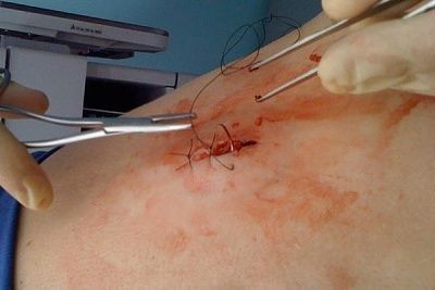 01-back-suture.jpg
