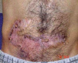 acne01th.jpg