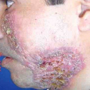 acne11.jpg
