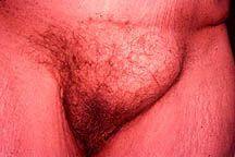 hernia-femaleth.jpg