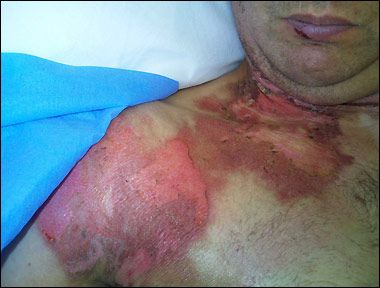 lightening burn.jpg