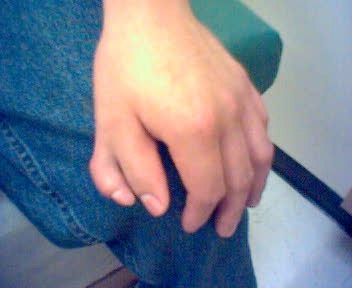 Polydactyly.jpg