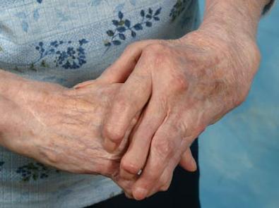 arthritis_hands-12380.jpg