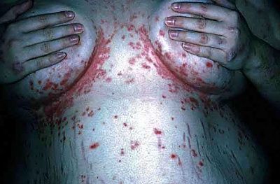 tinea_yb06-01.jpg
