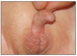 micropenis 1.jpg