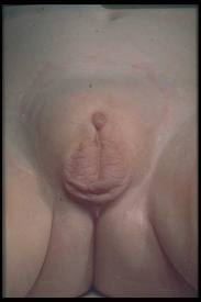 micropenis 2.jpg