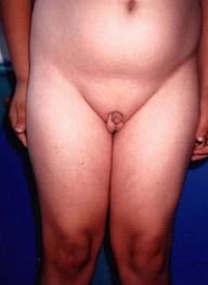 micropenis 4.jpg