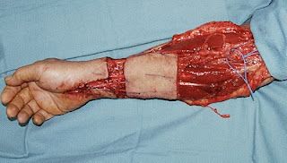 Radial Forearm Free Flap 3.JPG