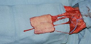 Radial Forearm Free Flap 4.JPG