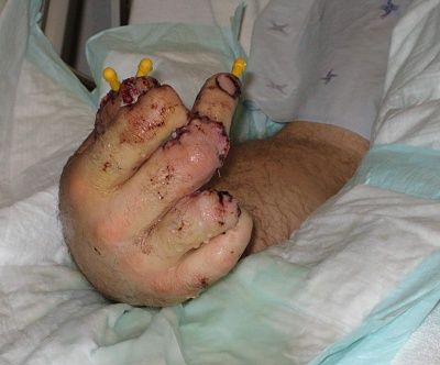 duane_hand_injury.jpg