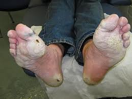 Trench Foot Symptoms: Immersion Foot and Gangrene - 0CAOG6VPACAQ099NWCAAMC10BCA04V99GCA2U1IOPCABOLBXGCAK2327HCAMVSGKUCAZA3ZPICACD3CJ3CAFZTCFWCAIHICB