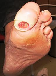Trench Foot Symptoms: Immersion Foot and Gangrene - 9CAFQEDK9CANDR9N4CAFSM0S4CA4BBFN4CAS6P6OACAYITZ3LCA933O19CA8EVYELCAZLBNL8CAUHDX91CAOIBHBHCAAAYZ5