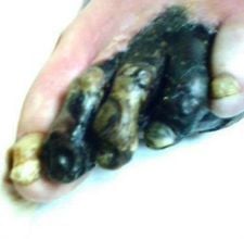 Trench Foot Symptoms: Immersion Foot and Gangrene - article page main ehow images a05 av r3 trench foot symptoms frostbite 800x800