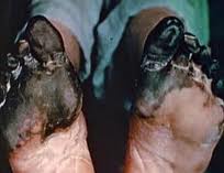 Trench Foot Symptoms: Immersion Foot and Gangrene - FCANJIBYZCA0CI4CVCAQQJ5B3CAB0J7QTCAWNY9NSCAZOPZI8CADQFA3OCAZEYE3PCAHSF8R1CALICX27CA6LNYG1CA6F3WN