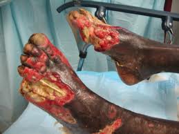 Trench Foot Symptoms: Immersion Foot and Gangrene - NCAO7K4XWCABME7JBCAWSLMH6CASBRYE2CA0DZQYZCAXLA136CAACQHVACAHSMQJECAOAD0XNCA418KMECADQN4YPCADBK97