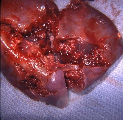 fractured-spleen-1-.jpg