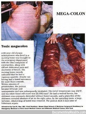 megacolon.jpg